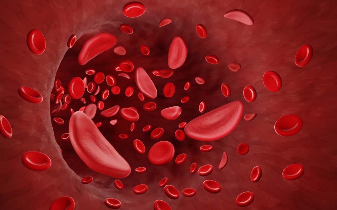 What You Need to Know About Sickle Cell Disease